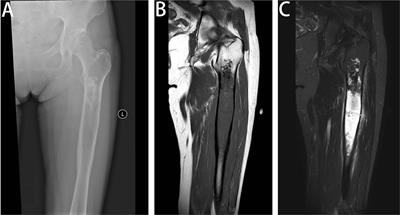 Dedifferentiated Central Chondrosarcoma: A Clinical, Histopathological, and Immunohistochemical Analysis of 57 Cases